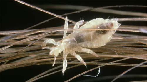 Quais os melhores tratamentos contra piolhos?