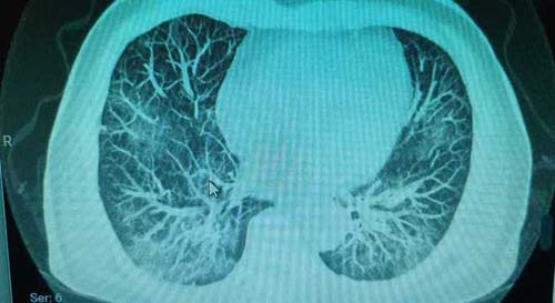 Pneumonia causada pela covid-19 pode ser silenciosa. Entenda