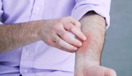 Psoríase, a doença crônica que afasta pacientes da 