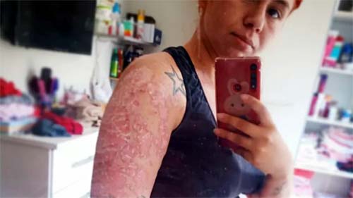 'Toda emoção negativa refletia na minha pele': a relação entre psoríase e saúde mental