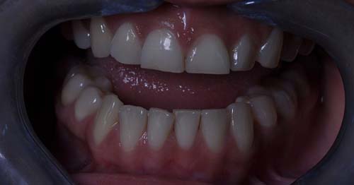 Bruxismo, um problema que atinge cerca de 20% da população