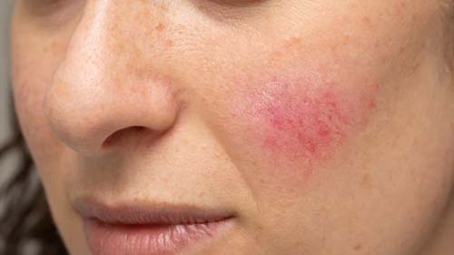 Saiba tudo sobre a Rosácea, doença vascular crônica e inflamatória