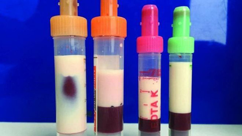 O homem cujo sangue ficou branco de tanta gordura