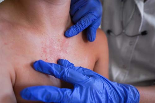 Aumento de casos de sarampo na Flórida preocupa especialistas em saúde pública