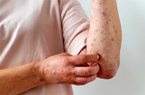 7 respostas para se proteger contra o sarampo, que volta a preocupar