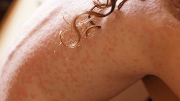 Sarna humana: doença contagiosa da pele causada por parasita