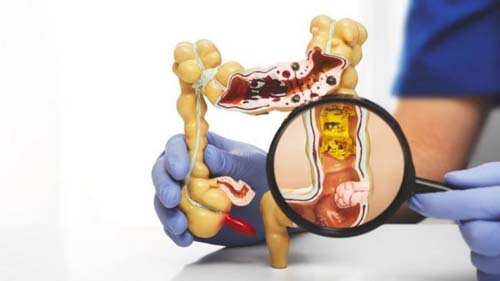 O que é a estenose diverticular do cólon, doença do papa Francisco