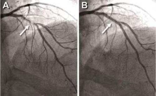 Santa Casa de Maceió amplia uso de “stents” farmacológicos no SUS