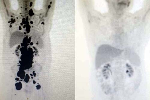 Anvisa autoriza pesquisa clínica de medicamento contra leucemia e linfoma