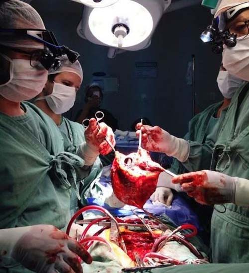 Mais de 400 pessoas aguardam por um órgão em Alagoas