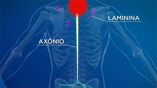 Avanços no Tratamento de Lesões na Medula Espinhal Aumentam as Expectativas de Recuperação