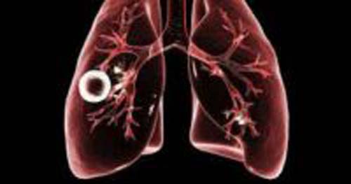 Tuberculose: A assassina de milhões todos os anos