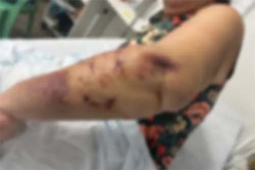 Mordidas em Praia de Paripueira deixam turista de Brasília hospitalizada após ataque de cães