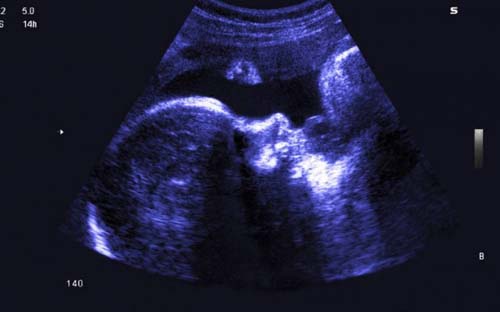 Nasce bebê gerado em útero transplantado de doadora morta