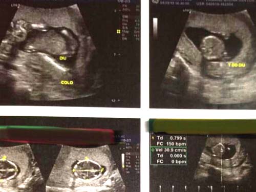 Conselho de Medicina vai investigar aborto de paciente que recebeu DIU de enfermeiro em Penedo