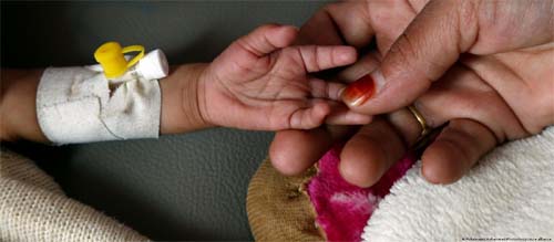 Unicef alerta para aumento das mortes por desnutrição