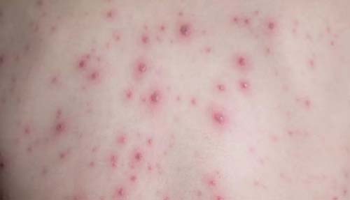 Sobe para 19 o número de casos suspeitos de varíola dos macacos em Alagoas; União dos Palmares não registrou nenhum caso