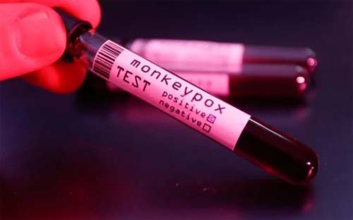 Com 5 descartados, AL tem 22 casos suspeitos de Monkeypox