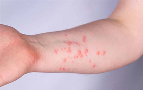 Semed nega que três estudantes da rede municipal de ensino estejam com varíola dos macacos