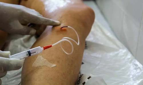 A cada dia, 145 mulheres são internadas para tratar varizes