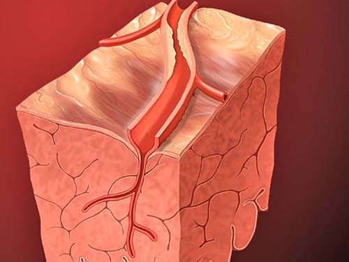 Estudo mostra que infarto pode acelerar declínio cognitivo
