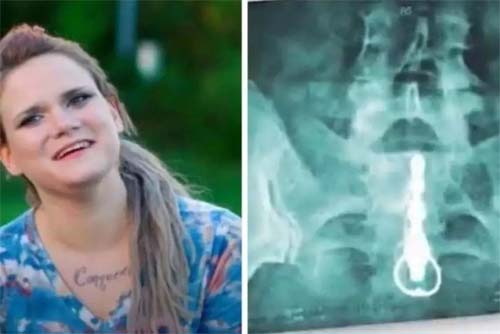 Mulher é hospitalizada com vibrador de 20 cm preso no reto