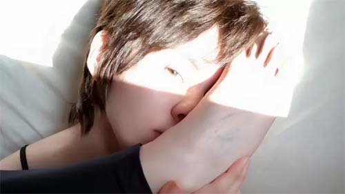 Síndrome de Ehlers-Danlos: a condição rara que gera 'pele elástica' e hipermobilidade